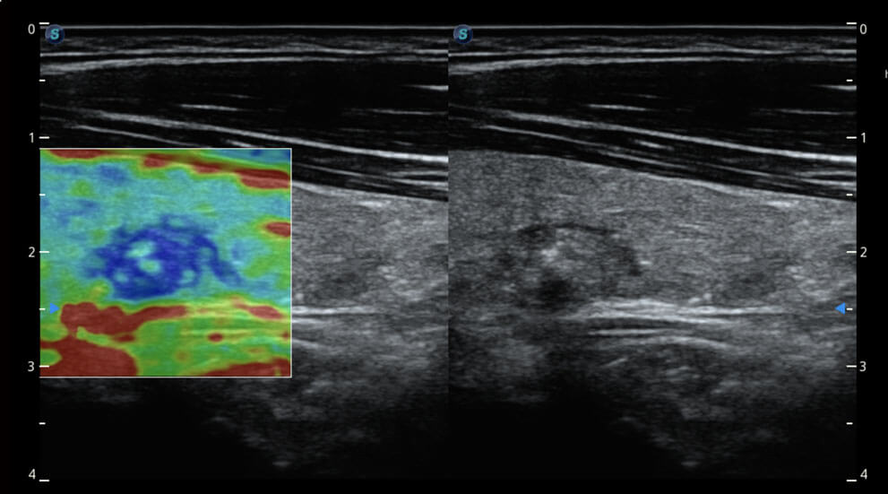 AVC Follicle P40