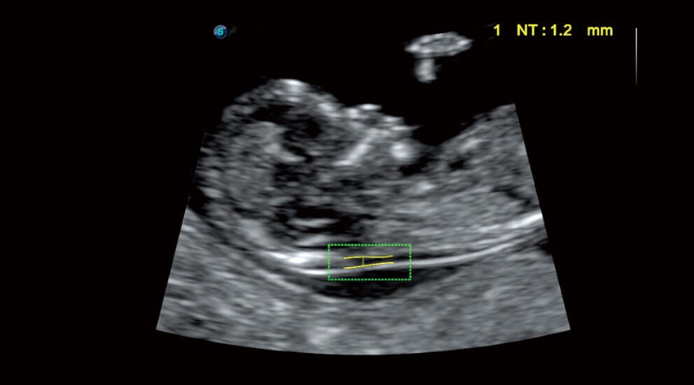 AVC Follicle P40